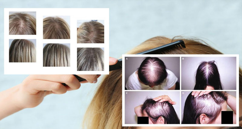 Hair Loss in Young Women