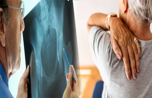 Early Signs of Osteoporosis in Women Over 40