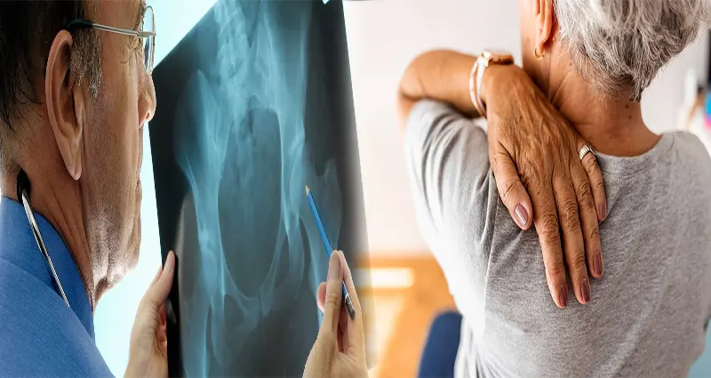 Early Signs of Osteoporosis in Women Over 40